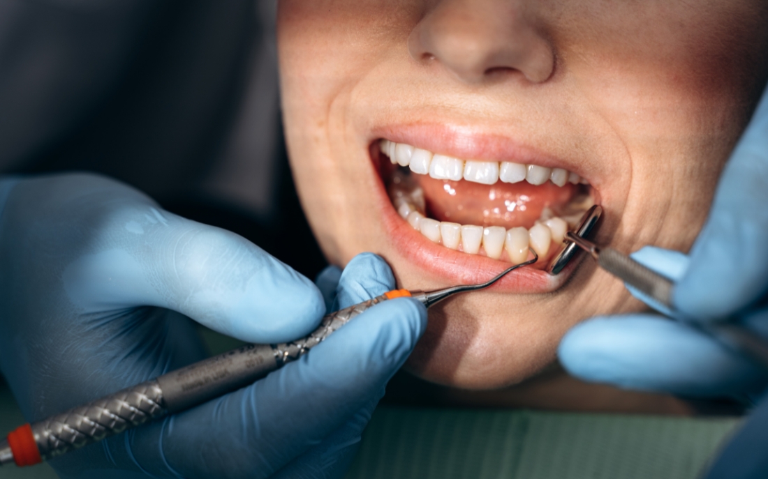 Don’t Ignore Bleeding Gums