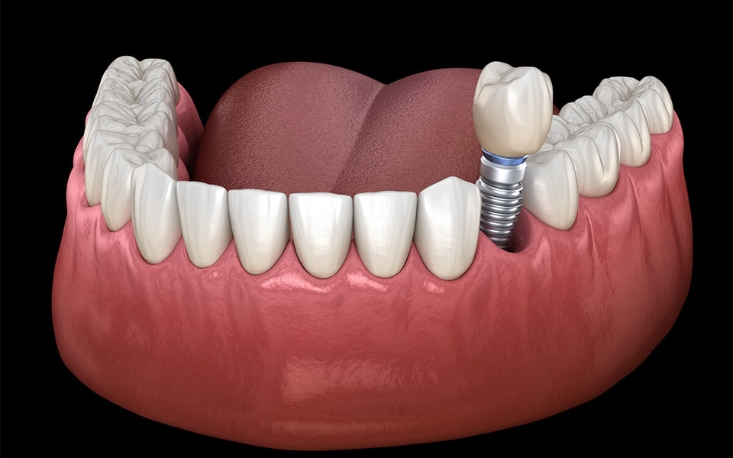 How Many Days Should You Rest After Getting A Dental Implant