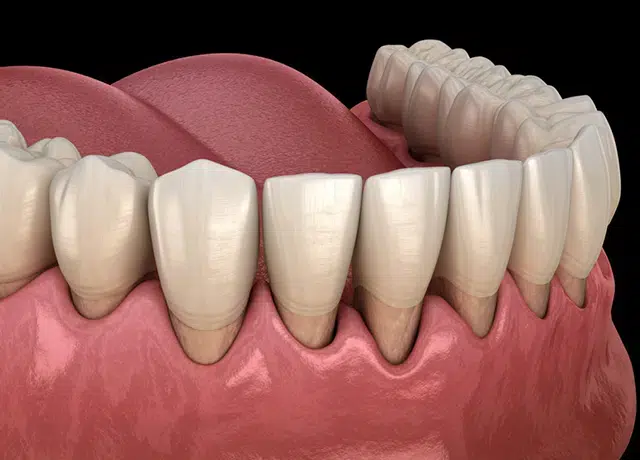 Periodontal Disease Treatment Easley Sc - Cove Dental Care