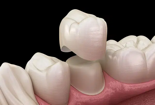 Dental Crowns Easley Sc - Cove Dental Care