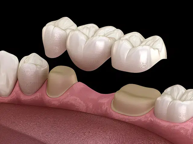 Dental Bridges Greer - Cove Dental Care