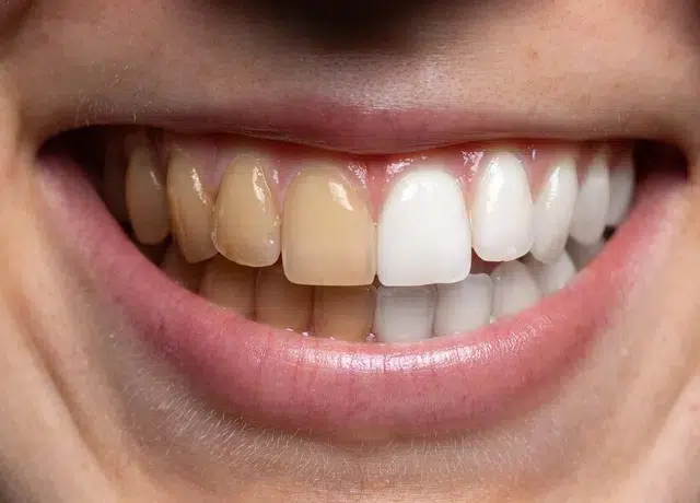 Teeth Whitening Greer Sc - Cove Dental Care